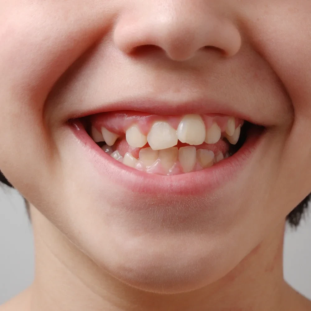 Crooked and crowded teeth showing need for braces treatment