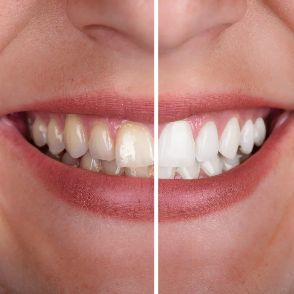 Before and after smile improvement with whiter and more even teeth