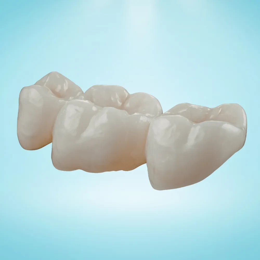 Dental bridge used to replace one or more missing teeth