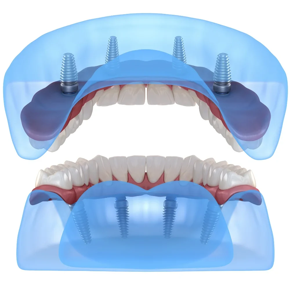 How full arch dental implants support a full set of replacement teeth