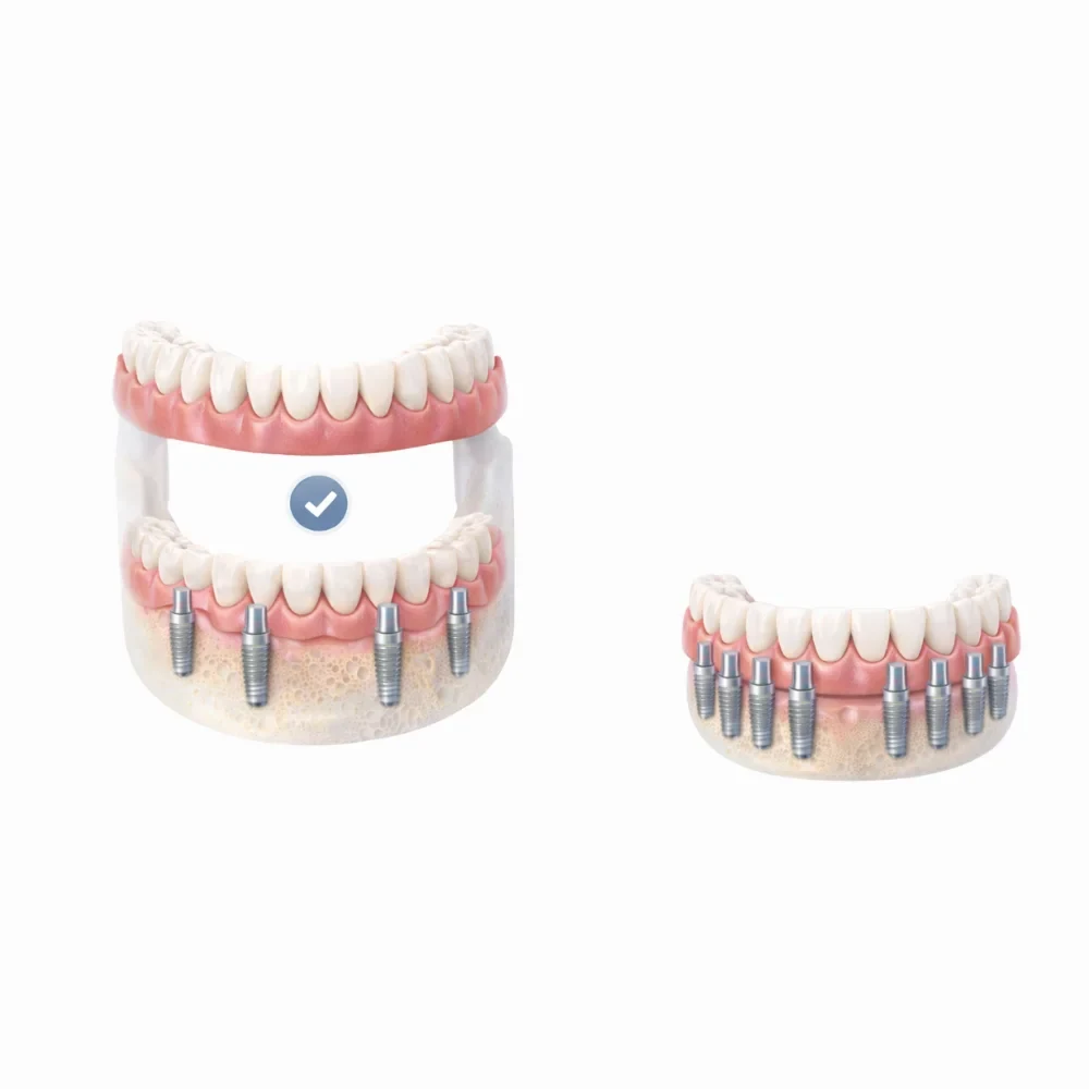 Full arch dental implants replacing all teeth in upper and lower jaw