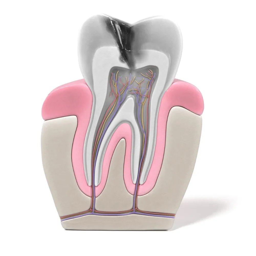 Tooth anatomy showing infected pulp and nerves requiring root canal treatment
