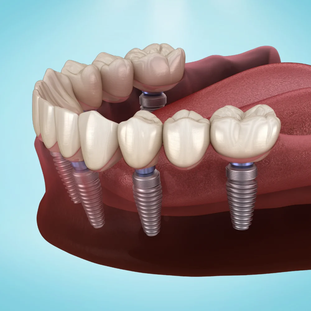 Full arch dental implants compared to traditional removable dentures