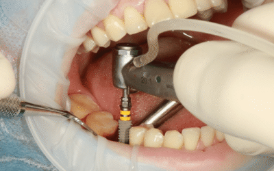 Why Kitchener Residents Are Choosing Dental Implants Over Dentures in 2026