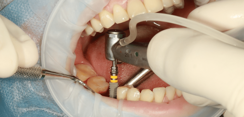 Close-up of dentist placing a dental implant into a patient’s jaw during a surgical procedure in Kitchener